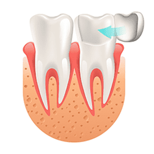 L’inlay-onlay dentiste à dijon