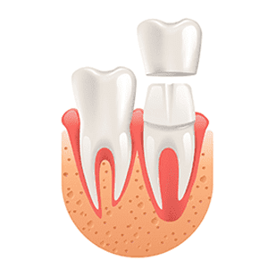 couronne dentaire dentiste à dijon