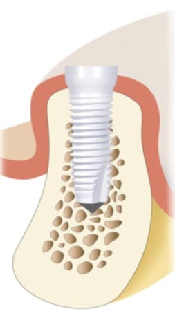 implant céramique
